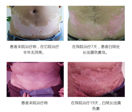 白斑治疗