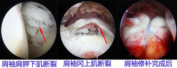 肩袖撕裂咋回事,因为肩袖妹妹都累断了 好大夫在线