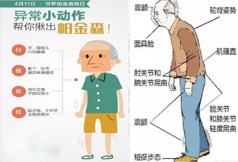 2019年健康宣教课第4期《律动生活—帕金森病的科学管理》