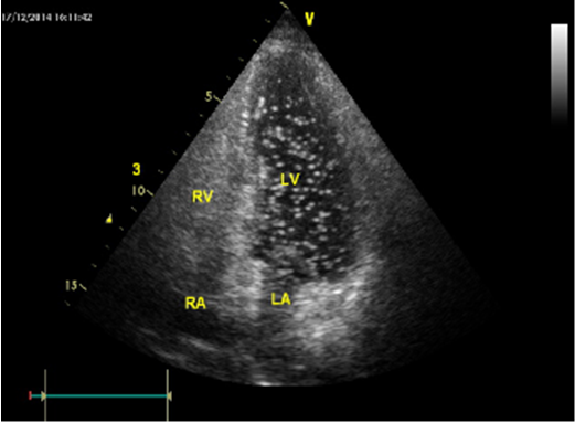 【医疗在线】你是我的"眼"——右心声学造影