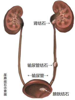 尿路结石怎么形成的图片