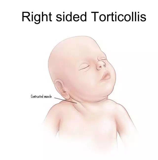 先天性斜颈图片 儿童图片