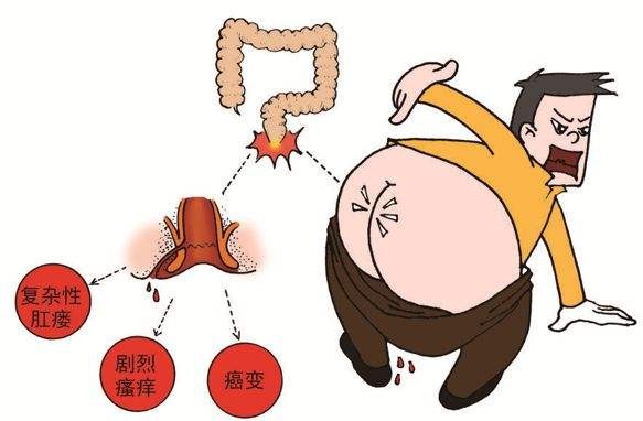 广州东大肛肠医院——肛瘘.jpg