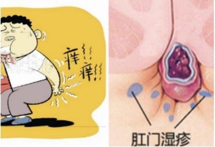 广州东大肛肠医院——肛周湿疹.jpg
