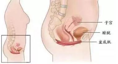 四川省生殖健康研究中心附属生殖专科医院告诉你什么是膀胱膨出?