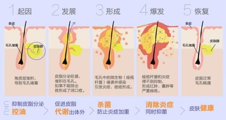 5.jpg 清颜祛痘方:中医治痤疮,还你一张白净脸