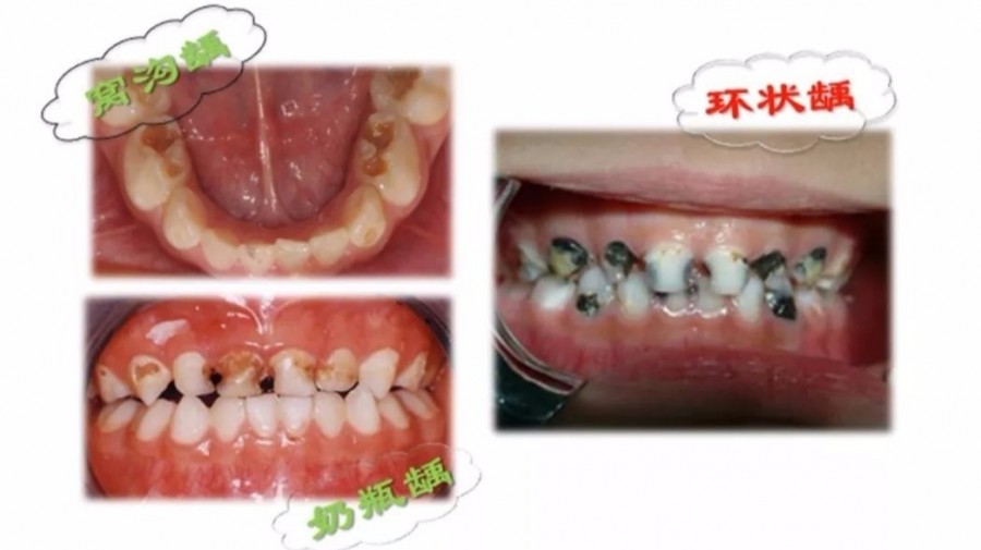 因為不當的餵食習慣造成飲品中的可發酵醣類長時間滯留在牙齒周圍所致